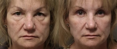 Vorher-Nachher-Fotos einer Augenlidoperation in Antalya.