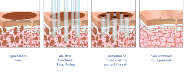 ablative fractional resurfacing laser diagram