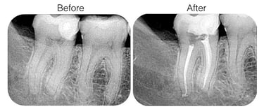 root canal treatment, affordable root canal treatment, best root canal near me, in sanpada