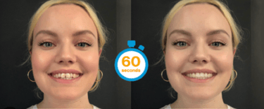 Invisalign simulation