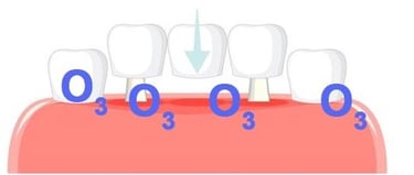 Higiene del puente dental hygiene-precision.com