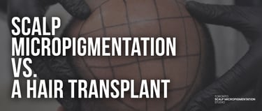 Scalp micropigmentation grid on a bald head comparing SMP vs hair transplant treatments.
