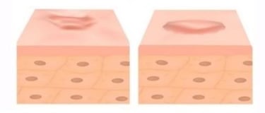 hypertrophic scar vs keloid scar