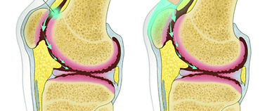 Dr.Rajinikanth's ortho clinic intra articular glucosamine