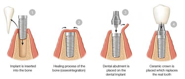 Dental implant steps Santiago Dominican Republic