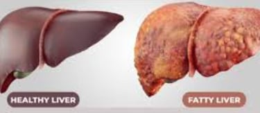 🩺The Only Hope for Patients : Fatty Liver