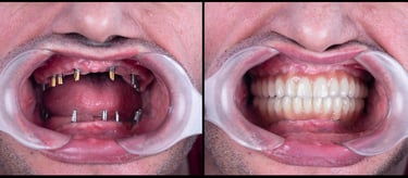 Affordable dental implants near me, Dental implants in nerul , Dental implants in sanpada, 