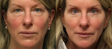 Vorher-Nachher-Fotos einer Augenlidoperation in Antalya.