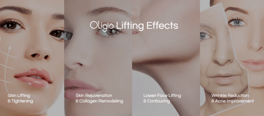 Oligio Monopolar Radiofrequency (RF) Skin Tightening
