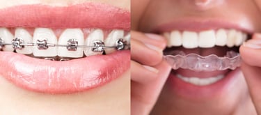 ortho braces in sanpada navi mumbai, aligners treatment for malaligned teeth, toothsi aligners