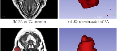 Example images of Pleomorphic Adenoma and Warthin’s Tumor
