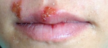 herpes simplex