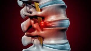 Illustration of spinal canal narrowing in lumber spinal stenosis.