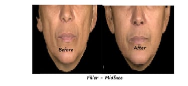 Before & after image fillers cheeks – restored volume, improved contour and natural fullness.