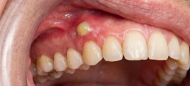Photo dental abscess hygiene-precision.com