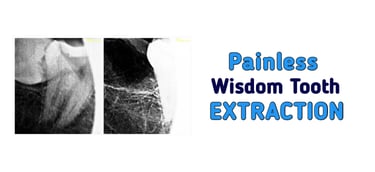 Painless Wisdom Tooth Extraction in Greater Noida