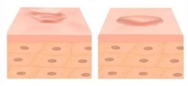hypertrophic scar vs keloid scar