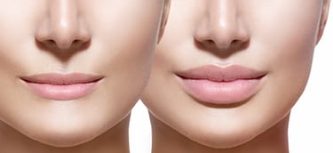 Buze injectate cu acid hialuronic