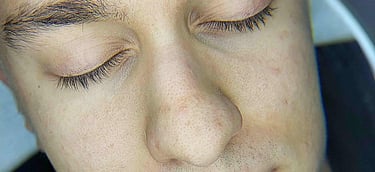 Arckezelés előtti állapot Veszprémben