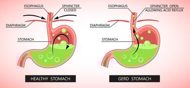 GERD stomach