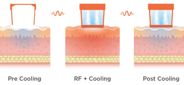 oligio monopolar radiofrequency skin tightening