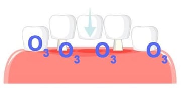 Hygiène du bridge dentaire soin jet dentaire ozone Aquolab hygiene-precision.com