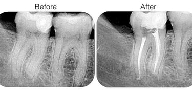 root canal treatment, affordable root canal treatment, best root canal near me, in sanpada