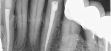 tratament canal dinti timisoara