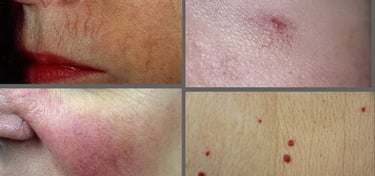 tratament IPl cuperoza, pete brune