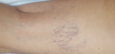 sclerozari vanectazii si varice timisoara