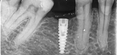 implantologie, implante timisoara