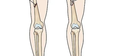 v femur shaft fracture