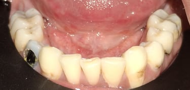 before rct showing carious front teeth at shree dental care ahmedabad