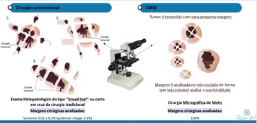Comparação entre a avaliação de margens no exame por congelação e na cirurgia micrográfica de Mohs