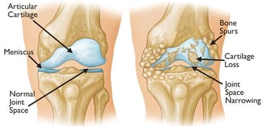 best knee replacement surgeon in bangalore