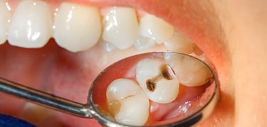 tratament carii dentare timisoara