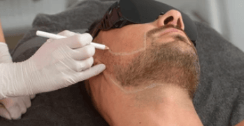 men face preperation for laser beard definition have laser protection on eye and therapis drow with white pencil aria to do t