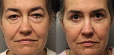 Vorher-Nachher-Fotos einer Augenlidoperation in Antalya.