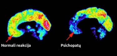 Smegenų nuskenuotas paveiklas, palyginantis psichopato ir normalias smegenis. Normalios ryškios.