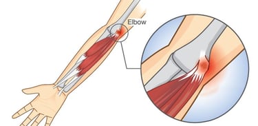 Dr.Rajinikanth's ortho clinic golfers elbow