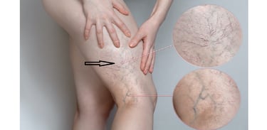 Bluish spider veins on legs and thighs before Sclerotherapy for cosmetic improvement.