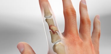 Dr.Rajinikanth's ortho clinic finger fracture