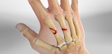 Dr.Rajinikanth's ortho clinic hand fracture