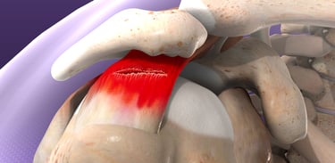 Dr.Rajinikanth's ortho clinic rorator cuff tear