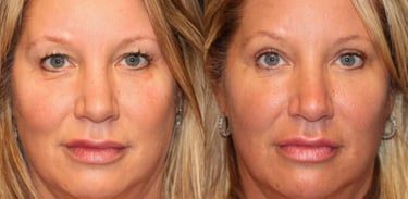 Vorher-Nachher-Fotos einer Augenlidoperation in Antalya.