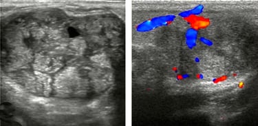 Ultrasound images of breast masses using color Doppler for hands-on training classes.