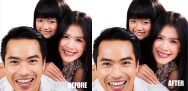 teeth-whitening