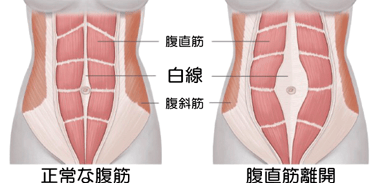 腹直筋離開