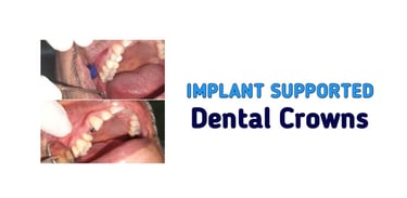 Implant Supported Dental Crowns