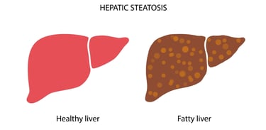 Comparison of healthy liver vs. fatty liver showing fat accumulation from carbohydrates.